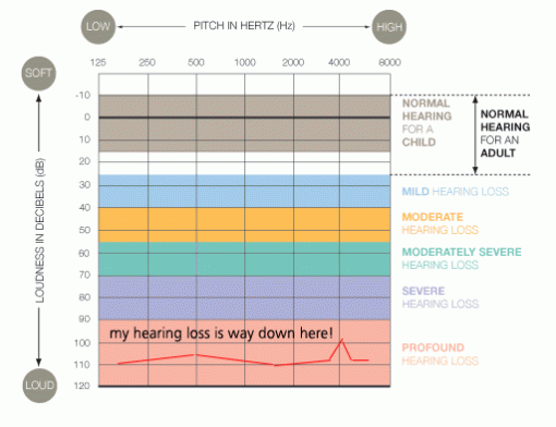 My hearing loss started in the mild to moderate level, and then deteriorated over 18 years to where it is today! At rock bottom (almost).